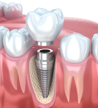 Dental implants