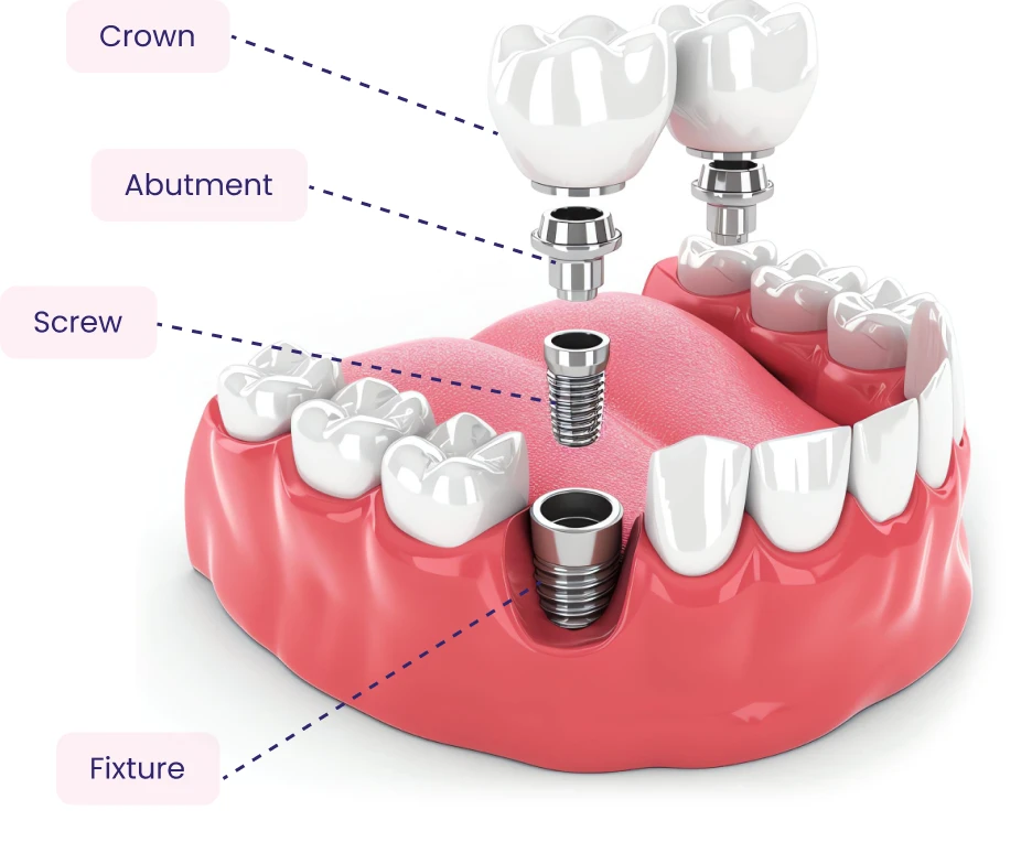 Dental implants